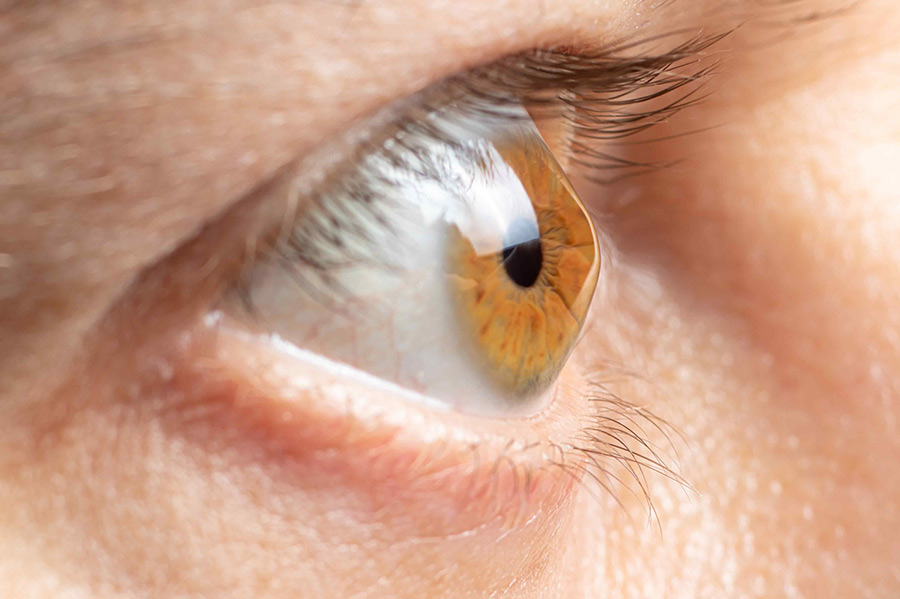 Close up of an man's eye with keratoconus