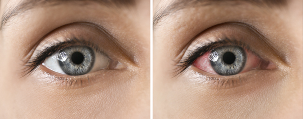 Close-up of a young woman's eye before and after dry eye treatment