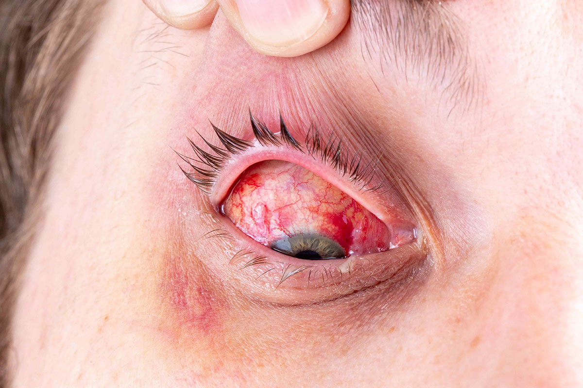 Close-up photograph of an eye with severe eye inflammation