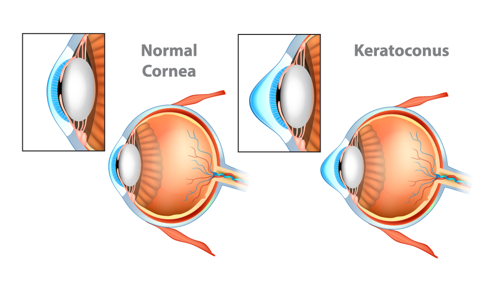 Side view illustration of a normal round-shaped cornea versus a diseased keratoconus cornea